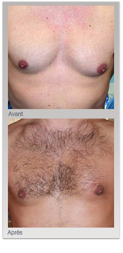 La gynécomastie ou présence de seins chez l'homme
